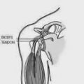 Τενοντίτιδα:θεραπεία με βότανα